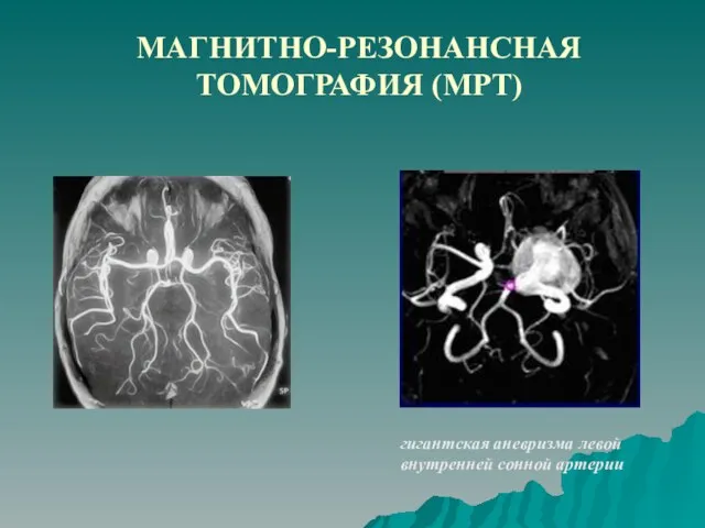 МАГНИТНО-РЕЗОНАНСНАЯ ТОМОГРАФИЯ (МРТ) гигантская аневризма левой внутренней сонной артерии