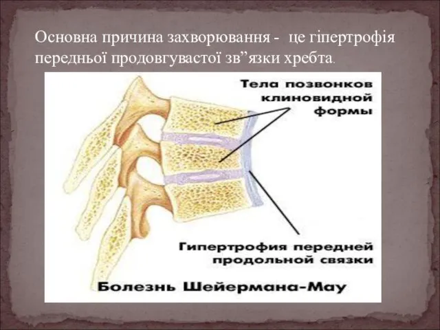 Основна причина захворювання - це гіпертрофія передньої продовгувастої зв”язки хребта.