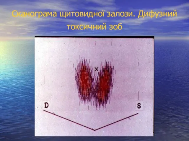 Сканограма щитовидної залози. Дифузний токсичний зоб