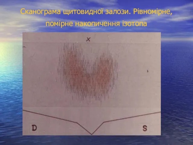 Сканограма щитовидної залози. Рівномірне, помірне накопичення ізотопа