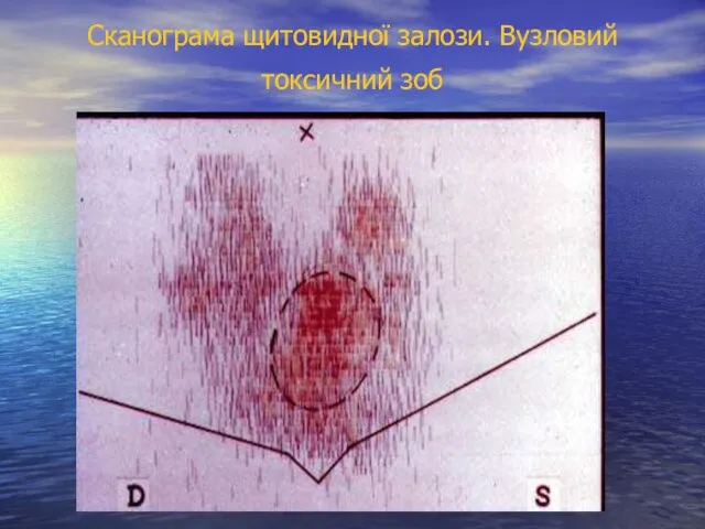 Сканограма щитовидної залози. Вузловий токсичний зоб