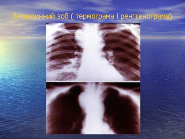 Загрудинний зоб ( термограма і рентгенограма)
