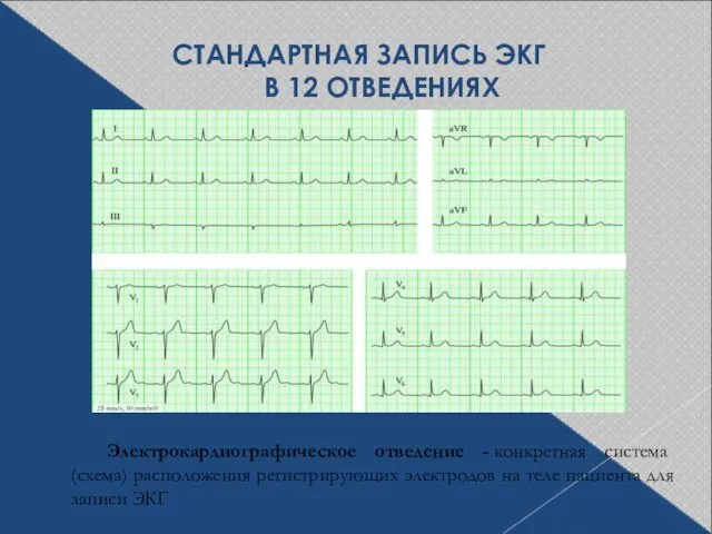 СТАНДАРТНАЯ ЗАПИСЬ ЭКГ В 12 ОТВЕДЕНИЯХ Электрокардиографическое отведение - конкретная система (схема)