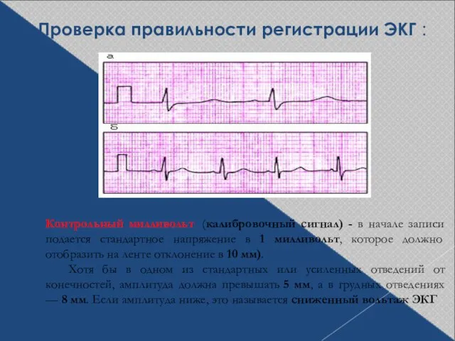 Проверка правильности регистрации ЭКГ : Контрольный милливольт (калибровочный сигнал) - в начале