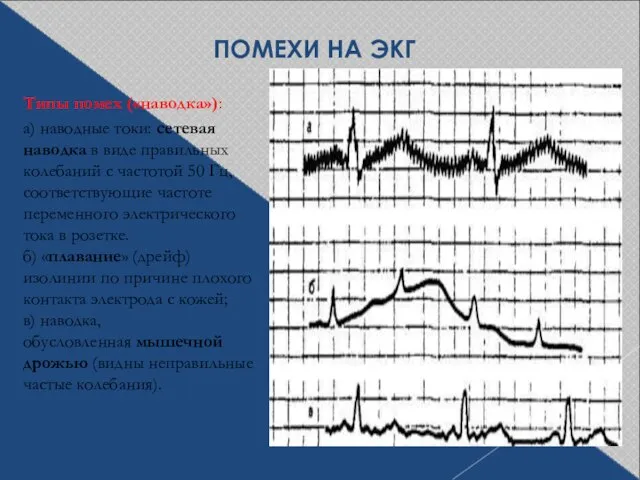 ПОМЕХИ НА ЭКГ Типы помех («наводка»): а) наводные токи: сетевая наводка в