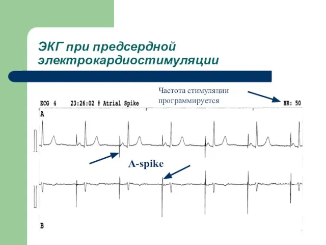 ЭКГ при предсердной электрокардиостимуляции A-spike Частота стимуляции программируется