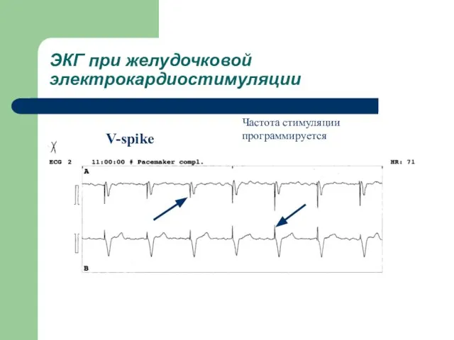 ЭКГ при желудочковой электрокардиостимуляции V-spike Частота стимуляции программируется