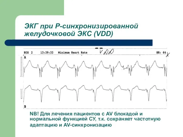 ЭКГ при Р-синхронизированной желудочковой ЭКС (VDD) NB! Для лечения пациентов с AV