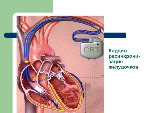 Кардио ресинхрони-зация желудочков