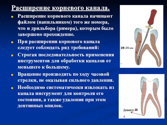 Расширение корневого канала. Расширение корневого канала начинают файлом (напильником) того же номера,