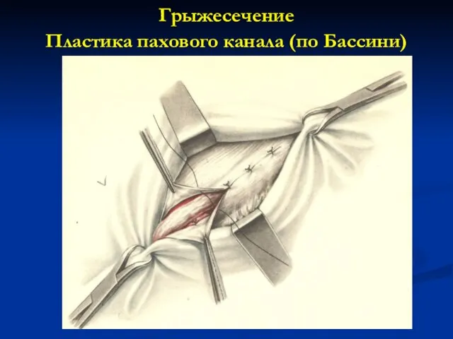 Грыжесечение Пластика пахового канала (по Бассини)