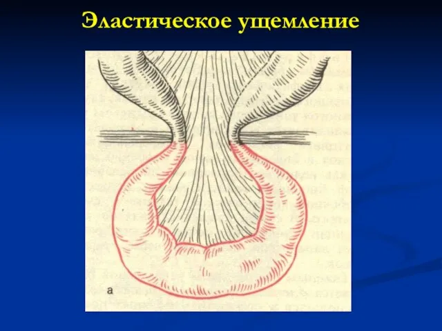 Эластическое ущемление