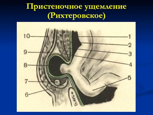 Пристеночное ущемление (Рихтеровское)