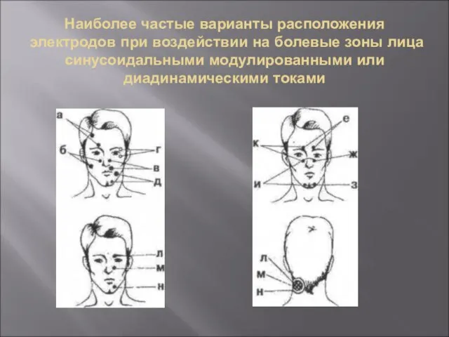 Наиболее частые варианты расположения электродов при воздействии на болевые зоны лица синусоидальными модулированными или диадинамическими токами