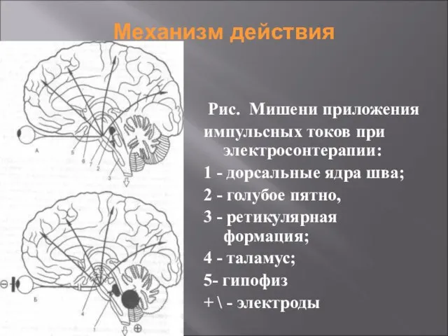 Механизм действия Рис. Мишени приложения импульсных токов при электросонтерапии: 1 - дорсальные