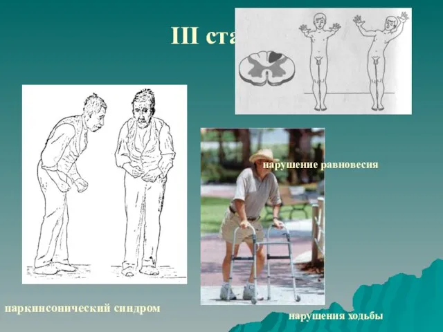 III стадия паркинсонический синдром нарушение равновесия нарушения ходьбы