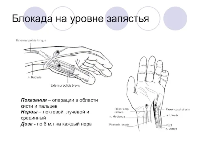 Блокада на уровне запястья Показания – операции в области кисти и пальцев