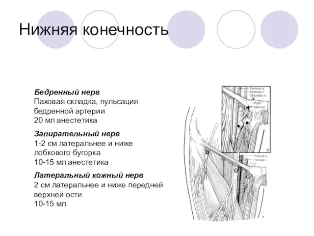 Нижняя конечность Бедренный нерв Паховая складка, пульсация бедренной артерии 20 мл анестетика