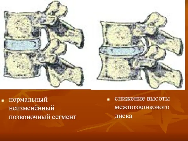 нормальный неизменённый позвоночный сегмент снижение высоты межпозвонкового диска