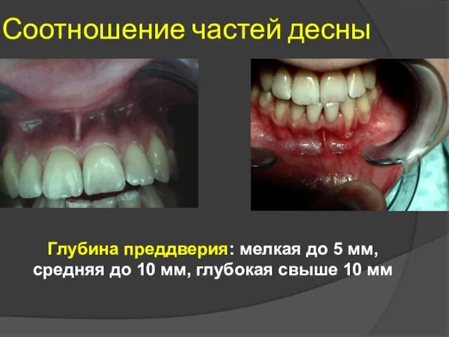 Соотношение частей десны Глубина преддверия: мелкая до 5 мм, средняя до 10