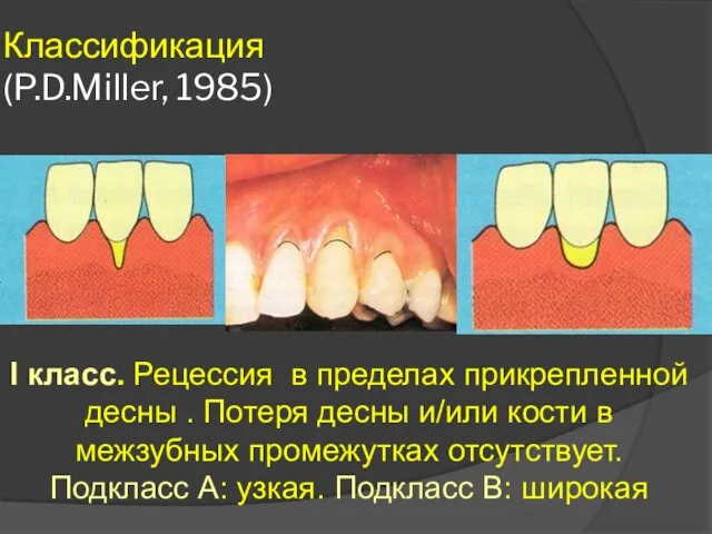 Классификация (P.D.Miller, 1985) I класс. Рецессия в пределах прикрепленной десны . Потеря