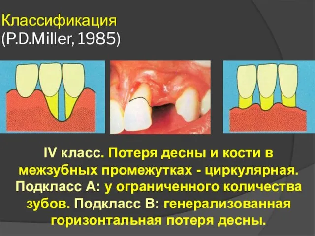 Классификация (P.D.Miller, 1985) IV класс. Потеря десны и кости в межзубных промежутках