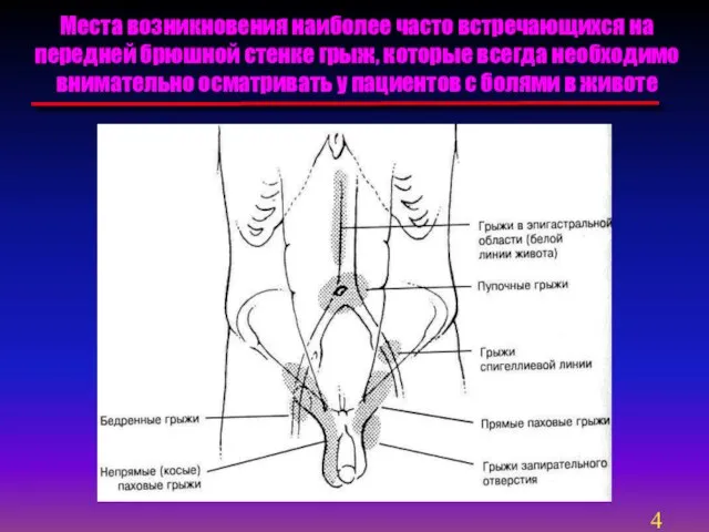 Места возникновения наиболее часто встречающихся на передней брюшной стенке грыж, которые всегда