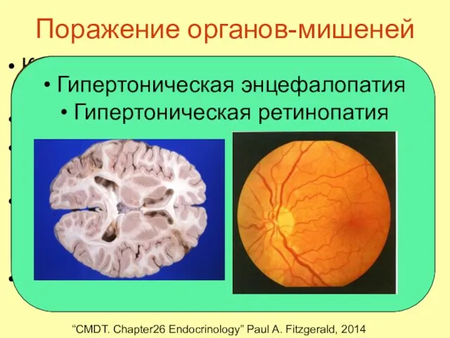 Поражение органов-мишеней Катехоламиновая дилатационная кардиомиопатия Ремоделирование сосудов Артериосклеротичекий нефросклероз (вплоть до ХБП)