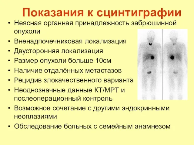 Показания к сцинтиграфии Неясная органная принадлежность забрюшинной опухоли Вненадпочечниковая локализация Двусторонняя локализация