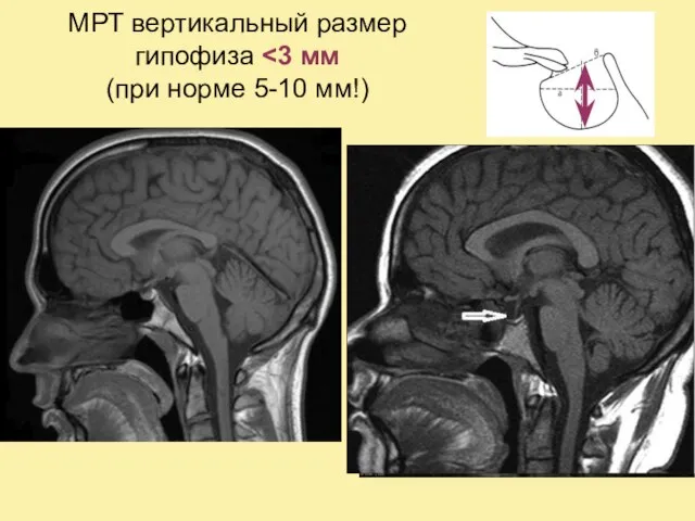 МРТ вертикальный размер гипофиза