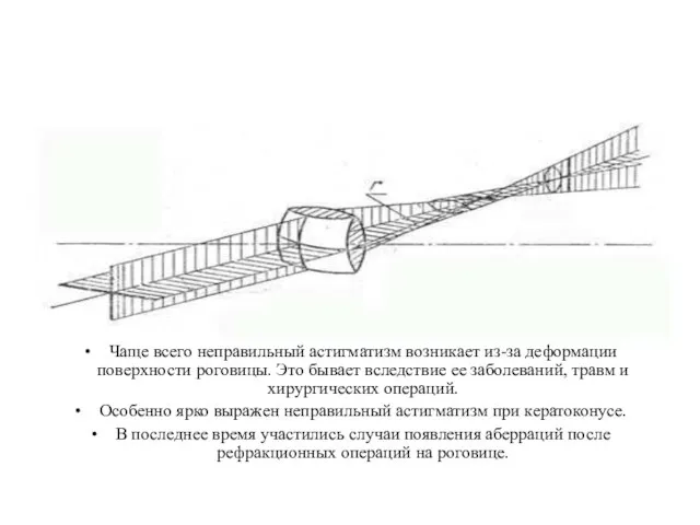 Чаще всего неправильный астигматизм возникает из-за деформации поверхности роговицы. Это бывает вследствие