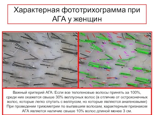 Характерная фототрихограмма при АГА у женщин Важный критерий АГА: Если все телогеновые