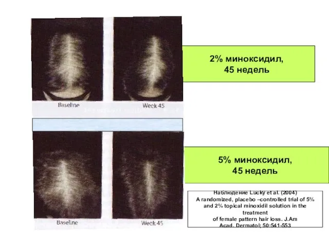 2% миноксидил, 45 недель 5% миноксидил, 45 недель Наблюдение Lucky et al.