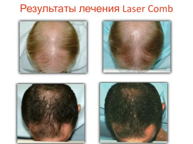 Результаты лечения Laser Comb