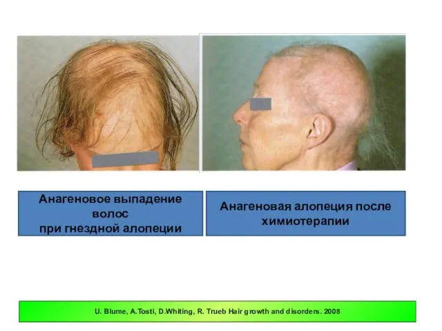 Анагеновое выпадение волос при гнездной алопеции Анагеновая алопеция после химиотерапии U. Blume,