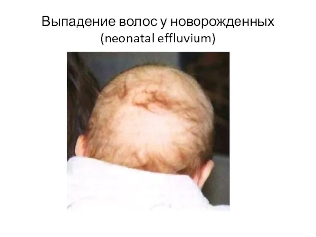 Выпадение волос у новорожденных (neonatal effluvium)