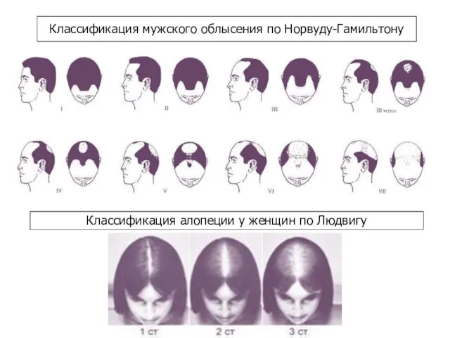 Классификация мужского облысения по Норвуду-Гамильтону Классификация алопеции у женщин по Людвигу