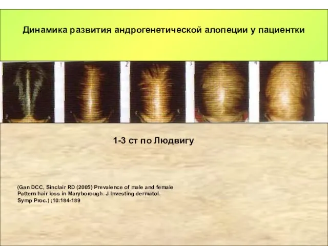 Динамика развития андрогенетической алопеции у пациентки 1-3 ст по Людвигу (Gan DCC,