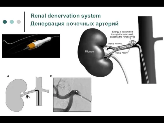 Renal denervation system Денервация почечных артерий