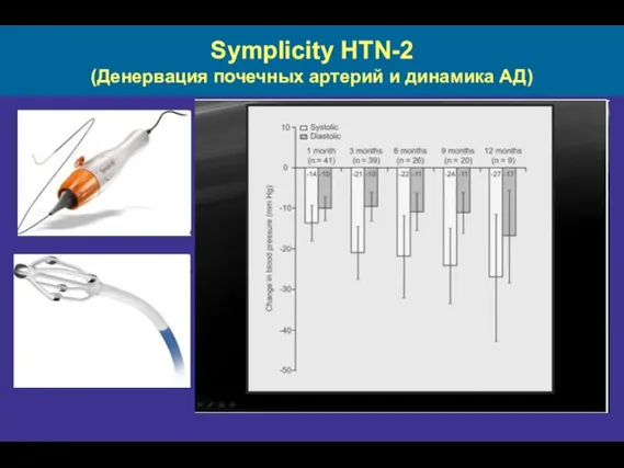 Symplicity HTN-2 (Денервация почечных артерий и динамика АД)