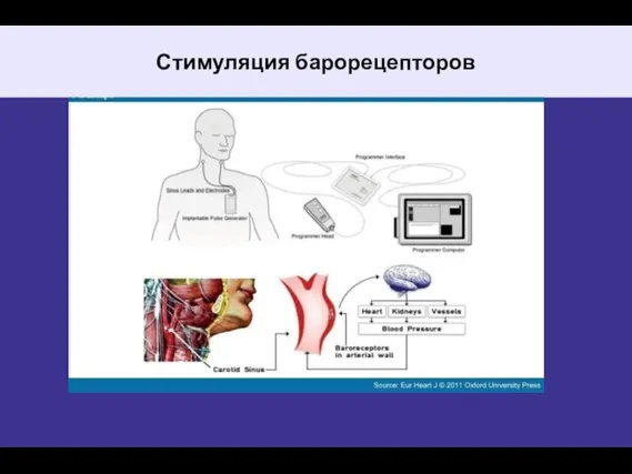 Стимуляция барорецепторов Стимуляция барорецепторов