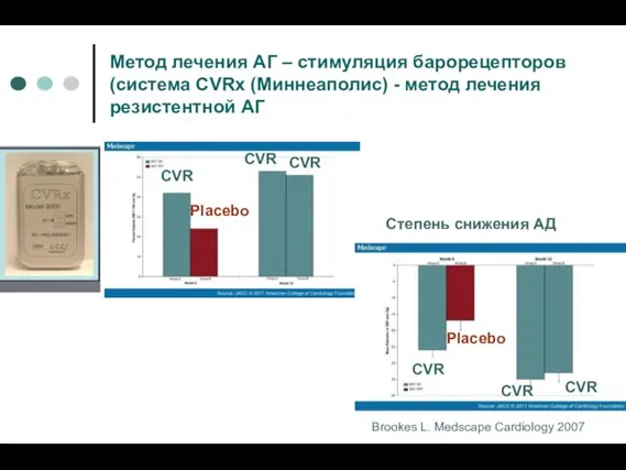 Метод лечения АГ – стимуляция барорецепторов (система CVRx (Миннеаполис) - метод лечения