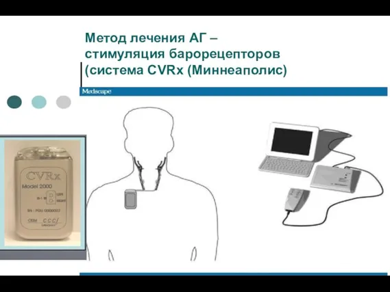 Метод лечения АГ – стимуляция барорецепторов (система CVRx (Миннеаполис)