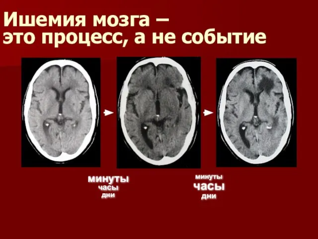 Ишемия мозга – это процесс, а не событие минуты часы дни минуты часы дни