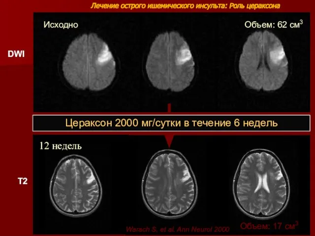 Лечение острого ишемического инсульта: Роль цераксона