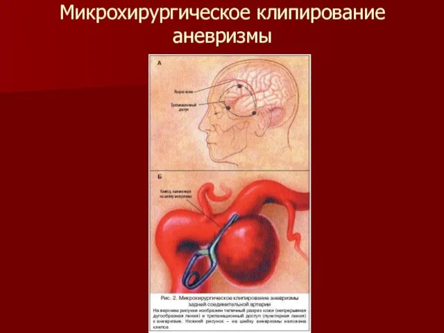 Микрохирургическое клипирование аневризмы