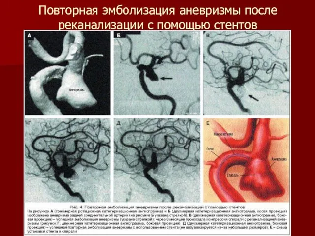 Повторная эмболизация аневризмы после реканализации с помощью стентов