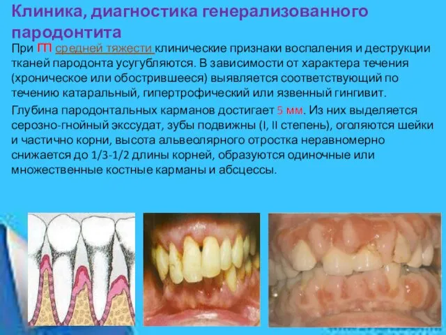 Клиника, диагностика генерализованного пародонтита При ГП средней тяжести клинические признаки воспаления и