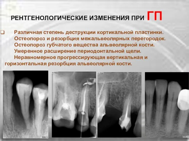 Различная степень деструкции кортикальной пластинки. Остеопороз и резорбция межальвеолярных перегородок. Остеопороз губчатого