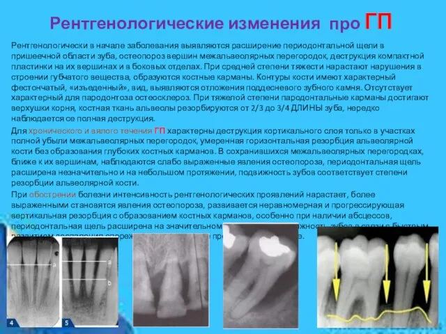 Рентгенологические изменения про ГП Рентгенологически в начале заболевания выявляются расширение периодонтальной щели